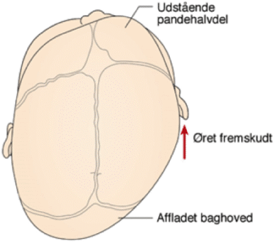 billede af surturerne og frontanellerne. plagiocephaly (skævt kranie).